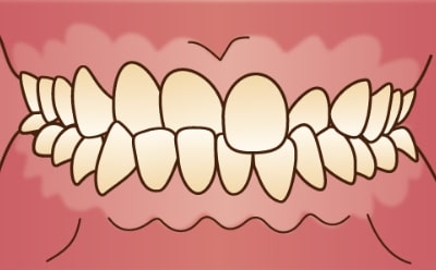 交叉咬合(クロスバイト）な歯の症例