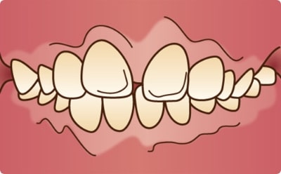 出っ歯（上顎前突)な歯の症例