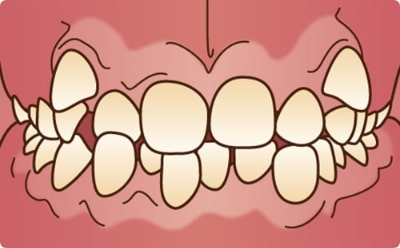 デコボコ･ガタガタな歯の症例